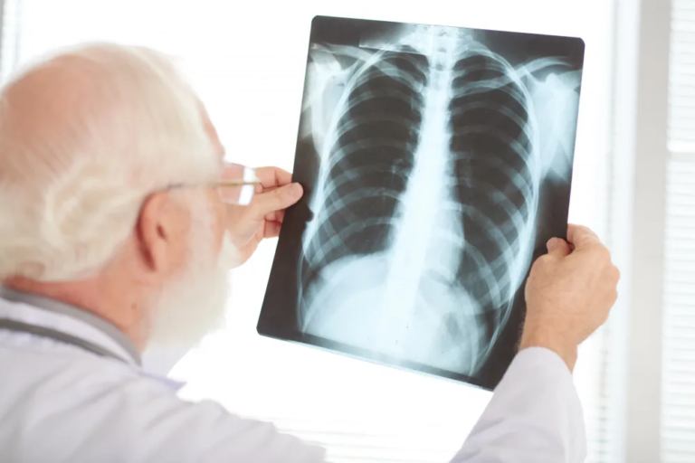 Scottish man looking at the lung x-ray result representing pleural plaques compensation claims.